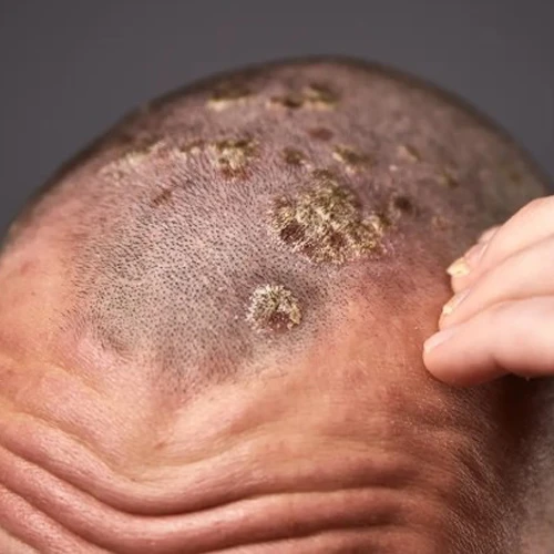 Psoriasis